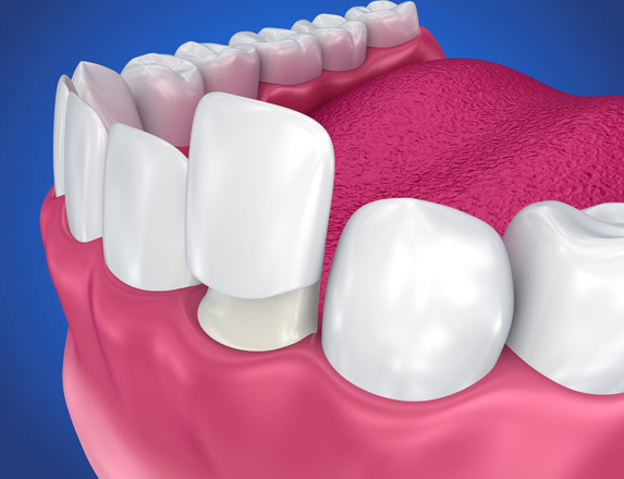 What Are Dental Crowns.jpg