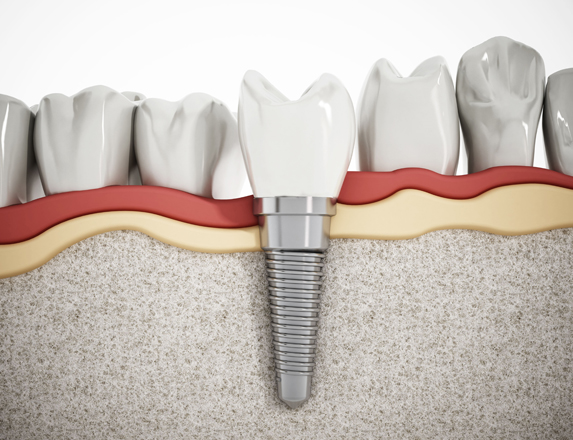 What Are Dental Implants.jpg